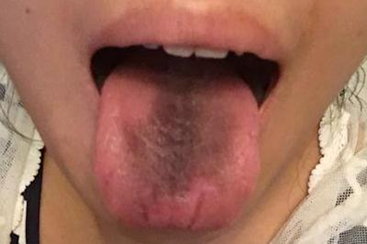 舌头发黑有裂痕图