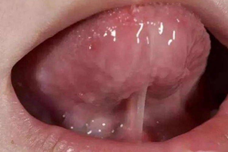 婴儿正常舌系带图