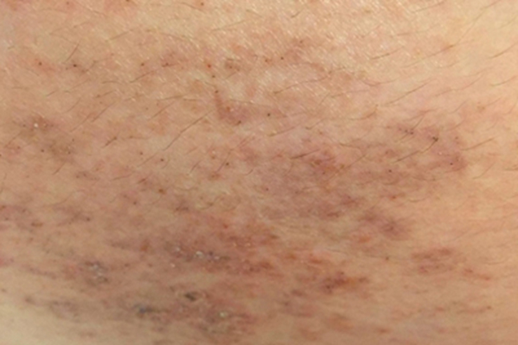 亚急性湿疹腹部斑图