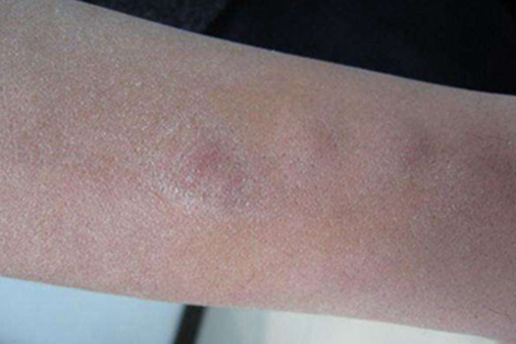 罗阿丝虫病硬块图