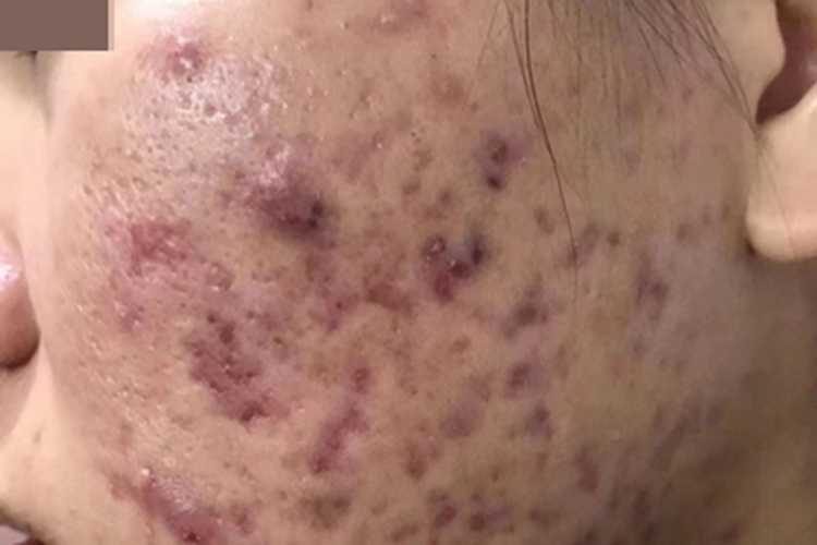 聚合性痤疮面部症状图