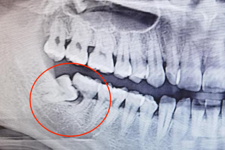 严重根尖周病图