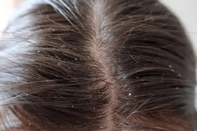 头皮鳞屑脱落图