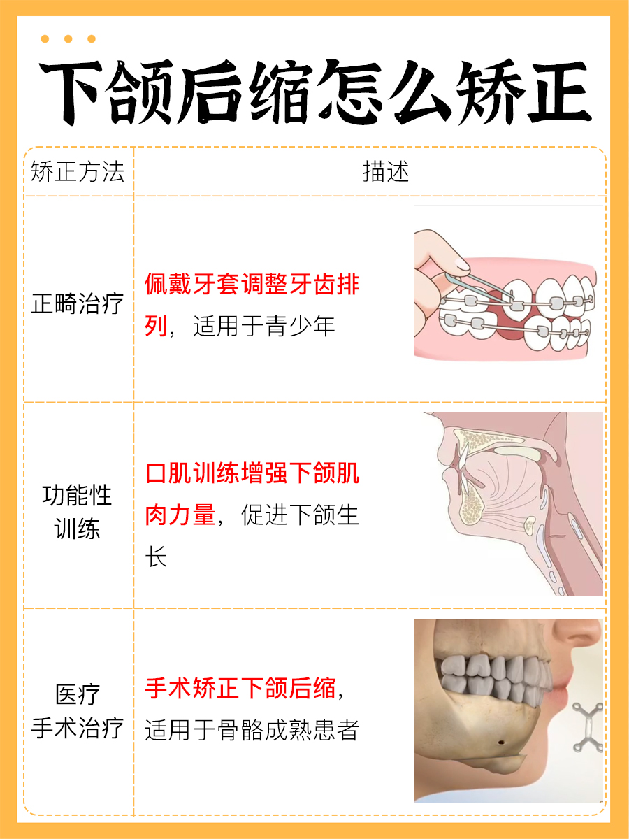 下颌后缩矫正攻略：医生告诉你