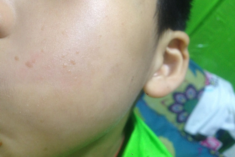 面部扁平疣扁平状图