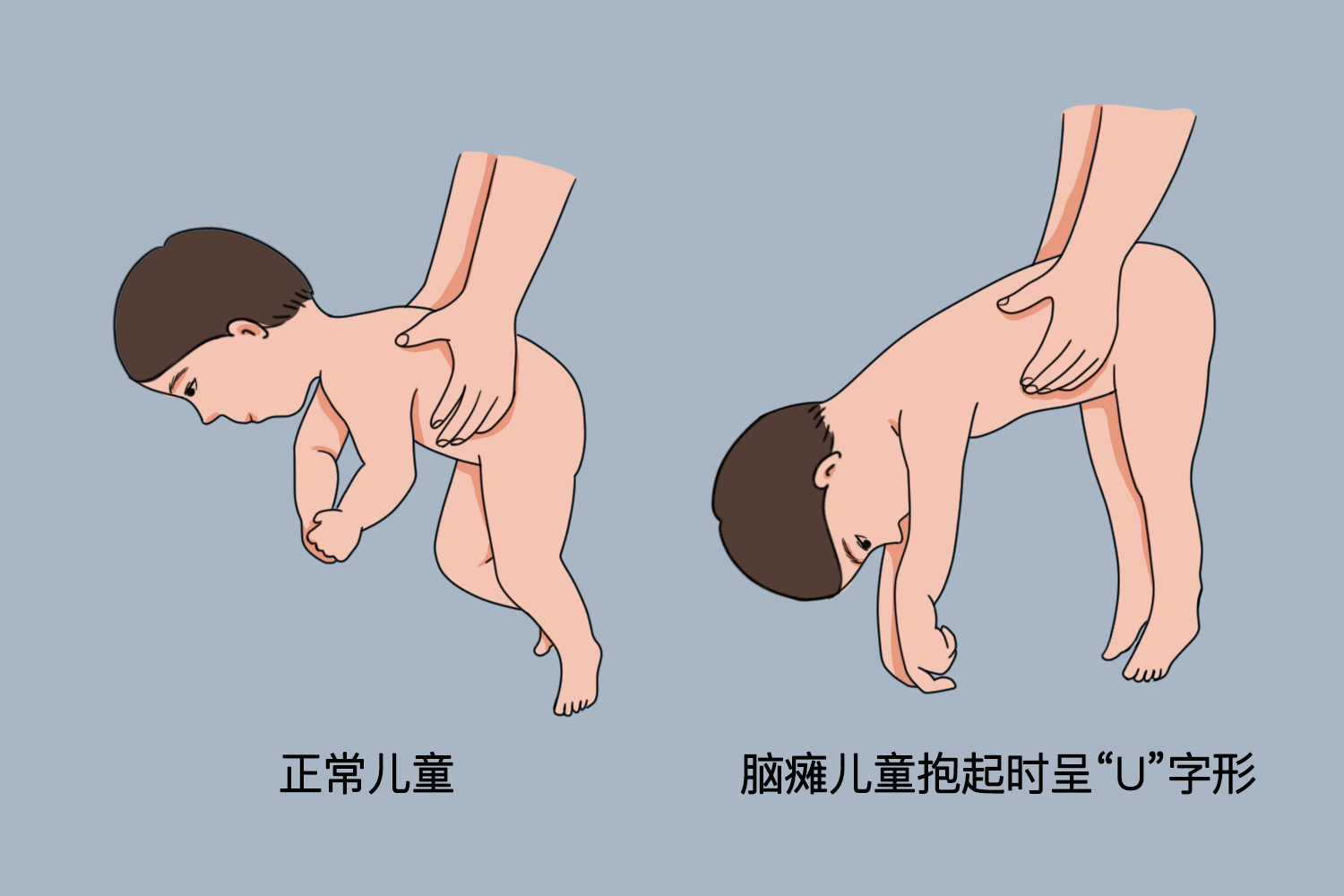 肌张力低下评估图 肌张力低下评估图