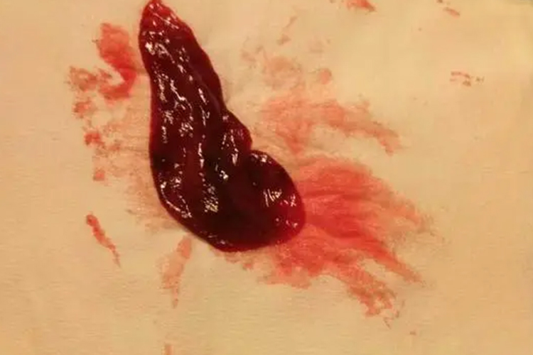 子宫内膜脱落图