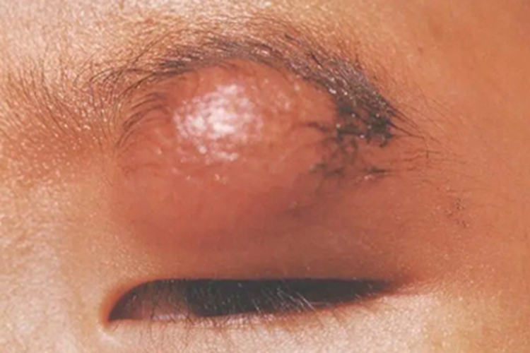 眼睑脓肿大疙瘩图