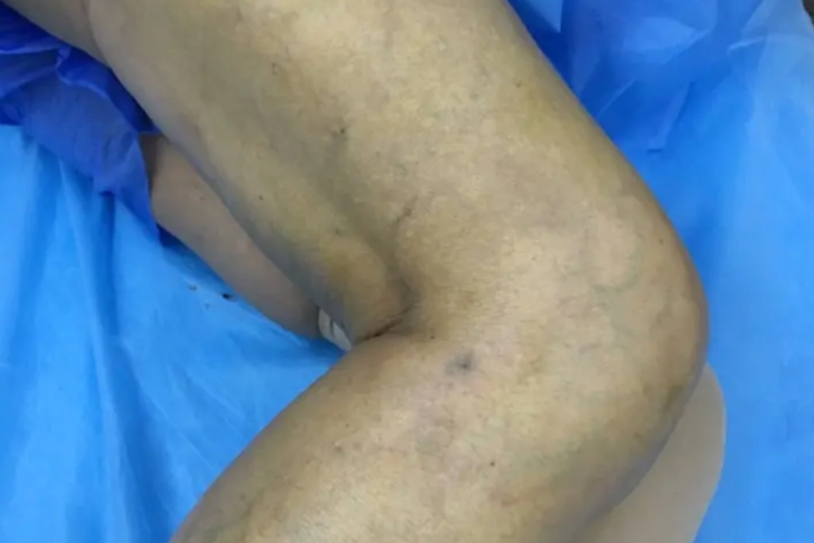 下肢静脉曲张初期症状图 下肢静脉曲张初期症状图