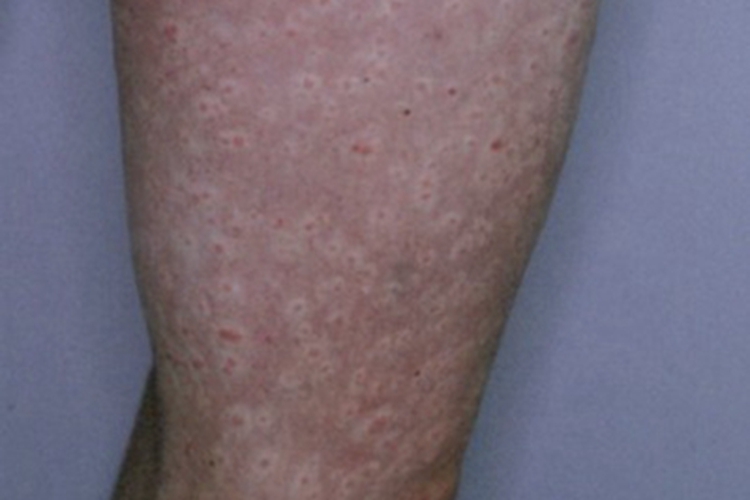 妊娠多形疹症状图 妊娠多形疹症状图