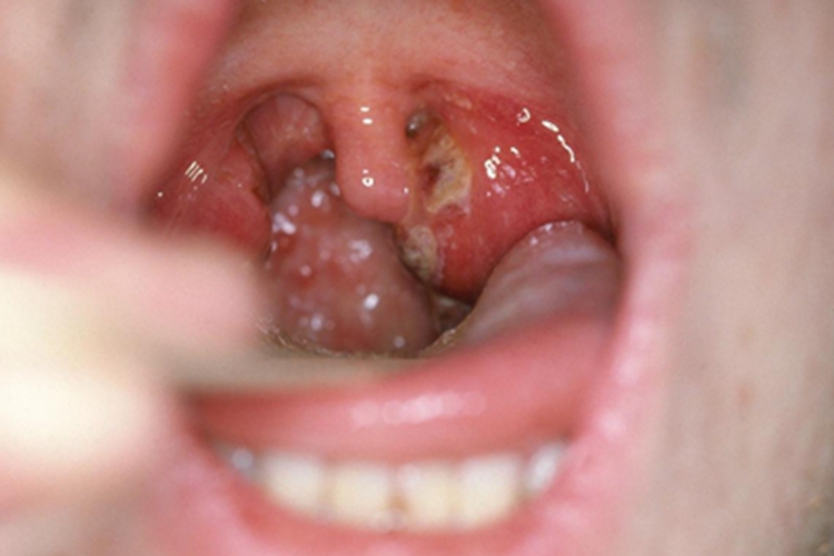 急性咽炎咽喉红肿图