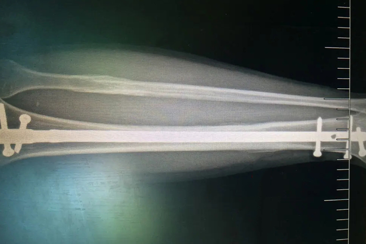 腓骨骨折骨小梁通过骨折线图 腓骨骨折骨小梁通过骨折线图