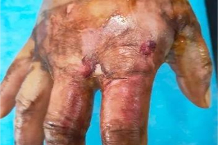 二度烫伤手背发红脱皮图