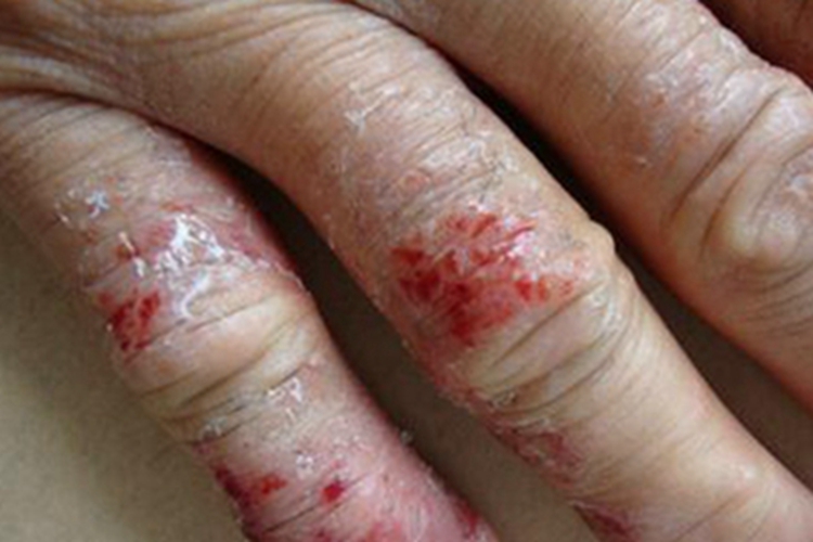 慢性湿疹手指破裂出血图 慢性湿疹手指破裂出血图
