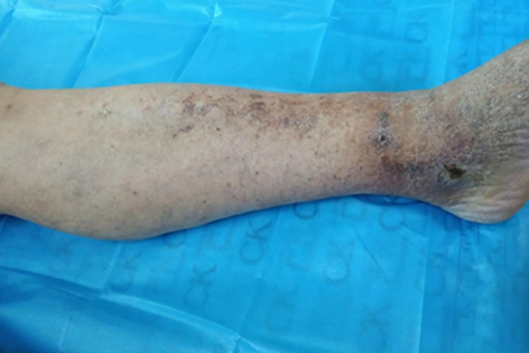 下肢深静脉血栓形成色素沉着图 下肢深静脉血栓形成色素沉着图