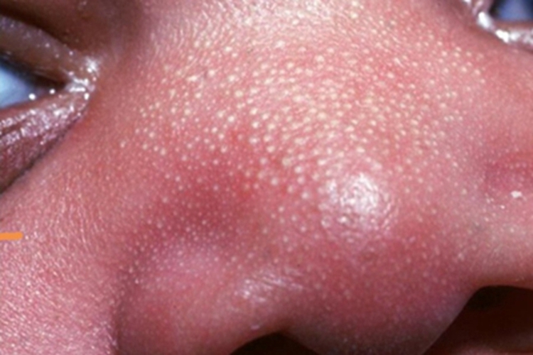 皮脂腺增生鼻部症状图<br />
##@@需裁剪