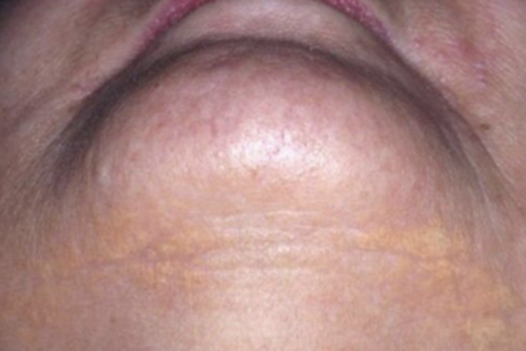 泛发性扁平黄色瘤下巴斑图