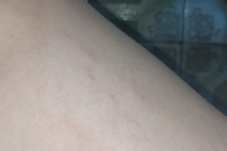 萎缩纹大腿上有弯曲的纹图