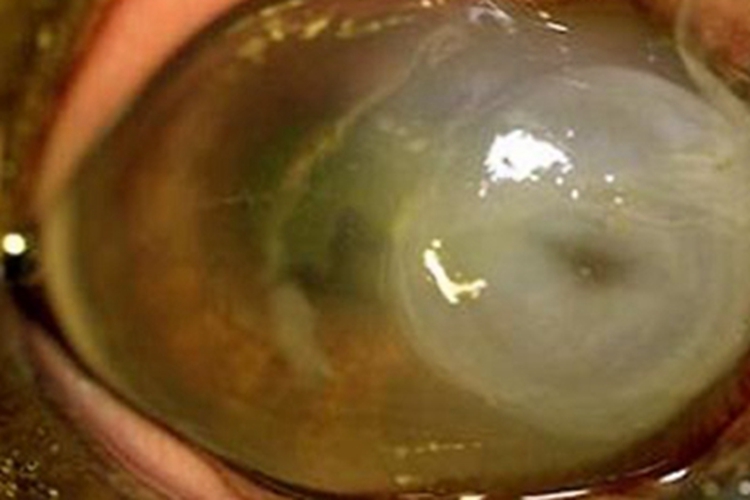 棘阿米巴角膜炎水疱图 棘阿米巴角膜炎水疱图