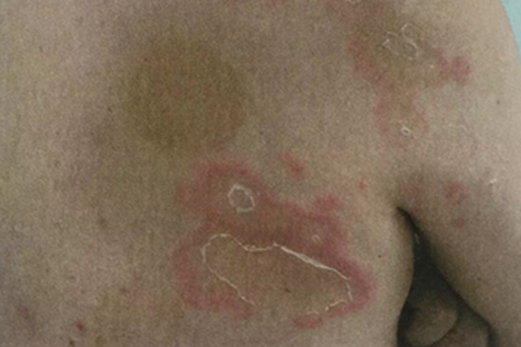 离心性环状红斑背部症状图 离心性环状红斑背部症状图