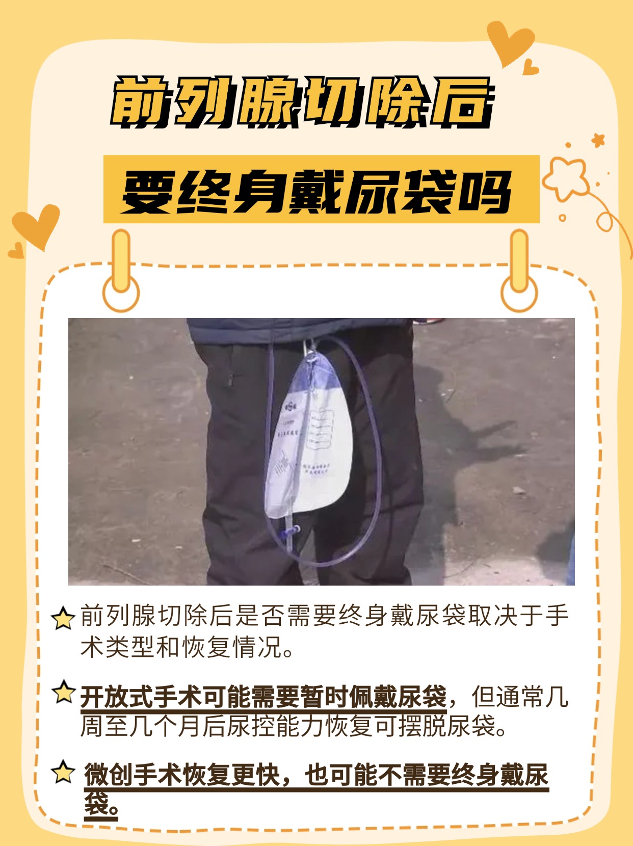 前列腺切除后是否需要终身戴尿袋？一文解析