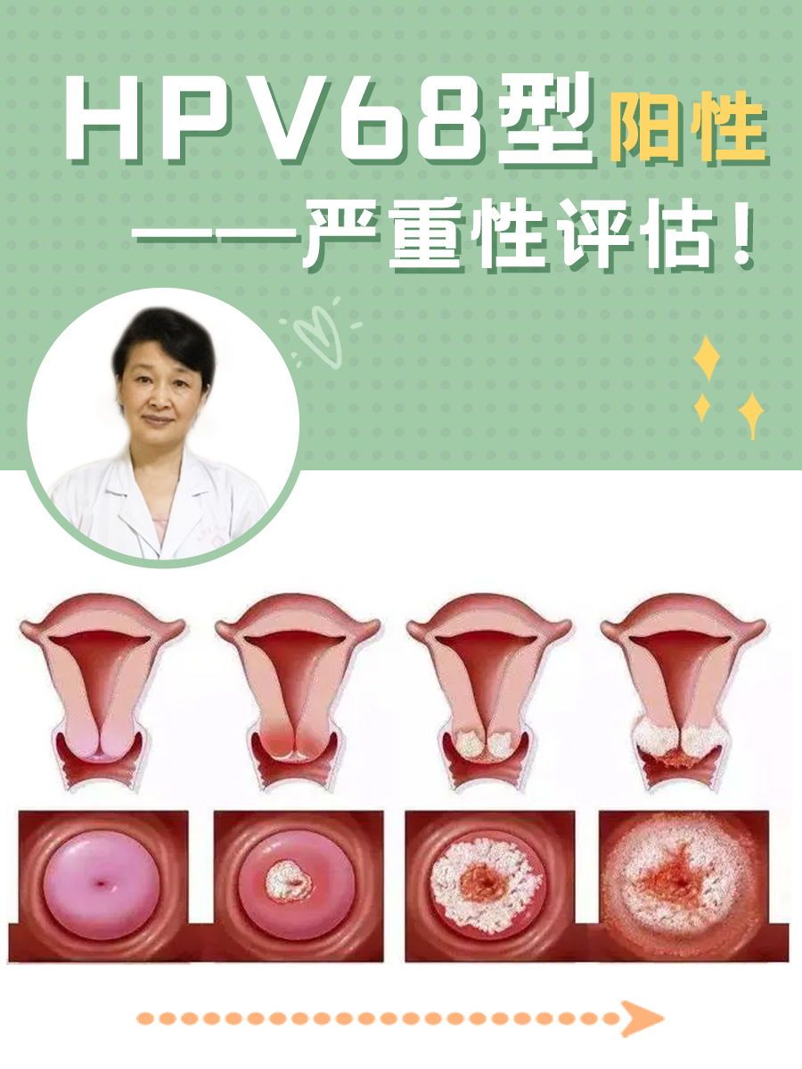 HPV68型阳性——严重性评估！