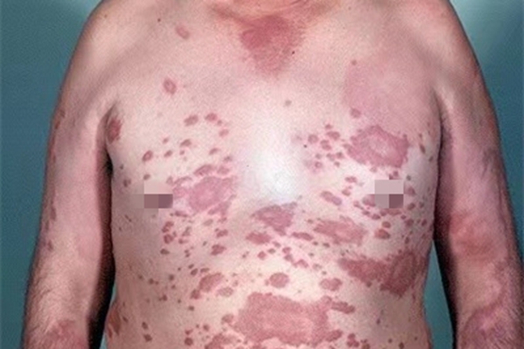 界限类偏瘤型麻风胸部症状图 界限类偏瘤型麻风胸部症状图