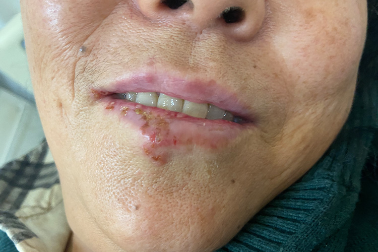 复发型口周破溃图