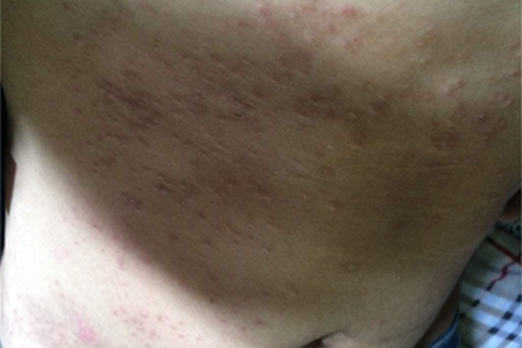短暂性棘层松解性皮病腹部症状图 短暂性棘层松解性皮病腹部症状图