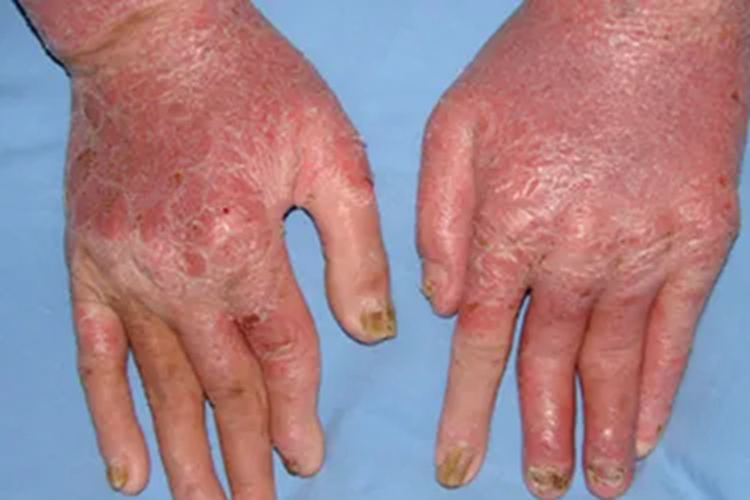 关节病型银屑病晚期图