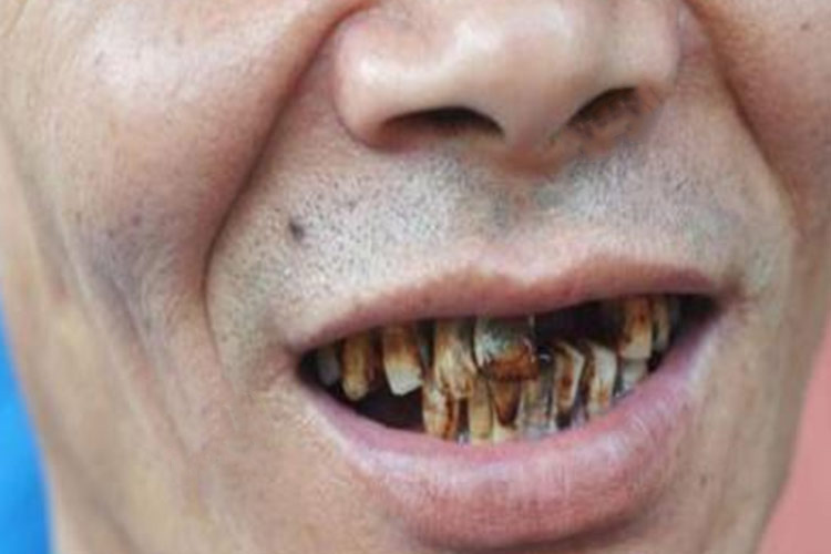 色素沉着牙齿黑斑与牙石图 色素沉着牙齿黑斑与牙石图