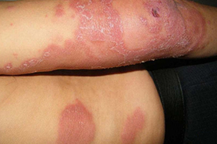 界限类偏结核样型麻风症状图 界限类偏结核样型麻风症状图