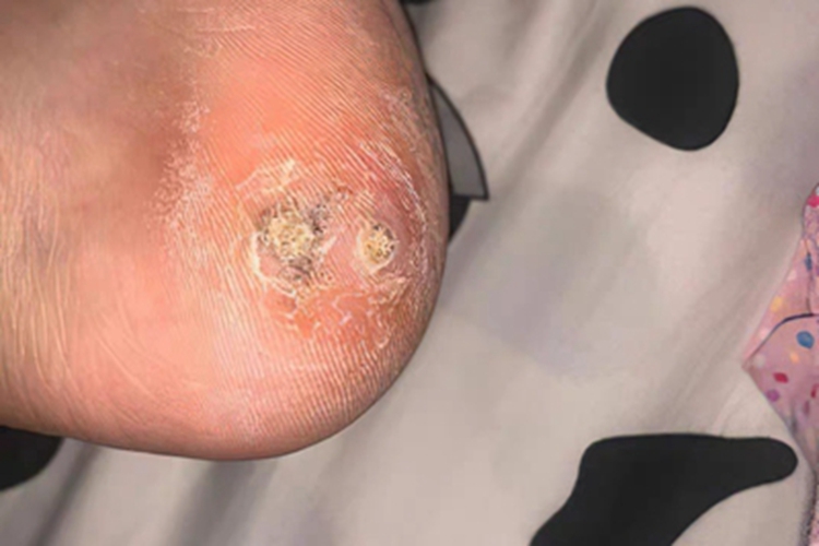 疣脚后跟脱屑图
