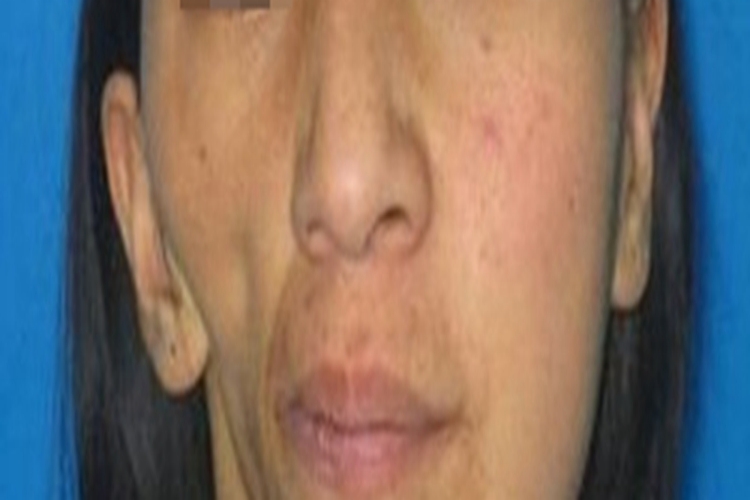 面部偏侧萎缩脸部畸形图 面部偏侧萎缩脸部畸形图