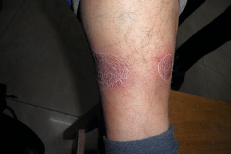 急性期硬化性脂膜炎小腿症状图 急性期硬化性脂膜炎小腿症状图