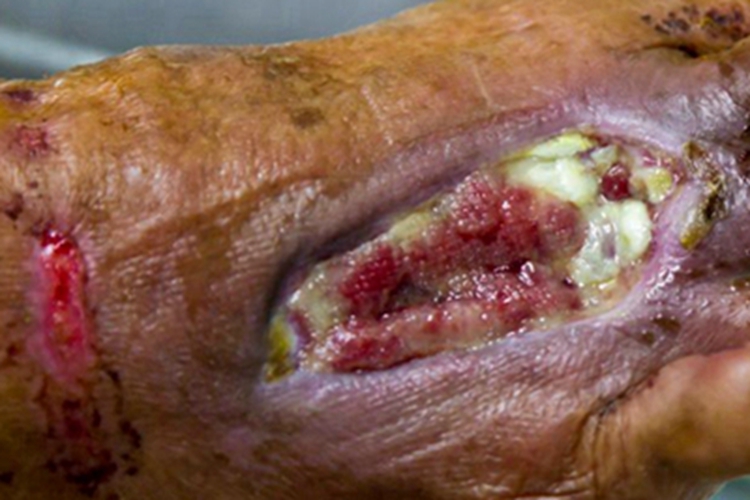 炭疽败血症脚烂了个坑图