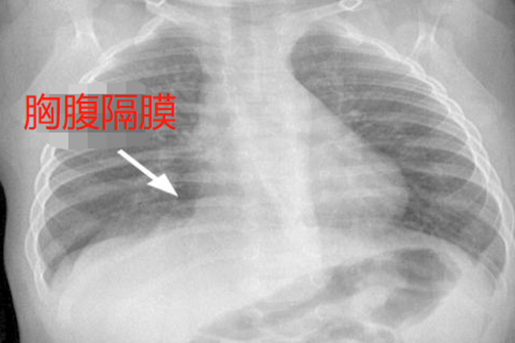胸腹隔膜位置图 胸腹隔膜位置图