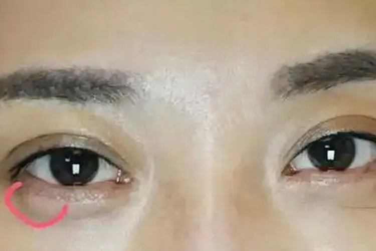 外切眼袋增生鼓包图