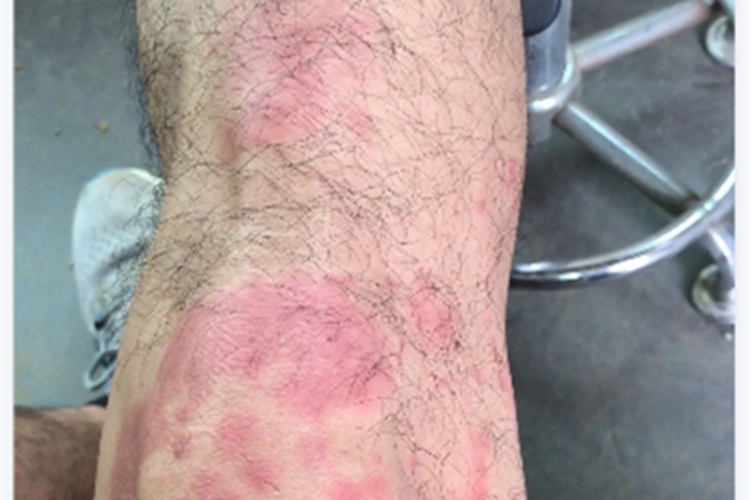 艾滋病急性感染期膝盖红斑图