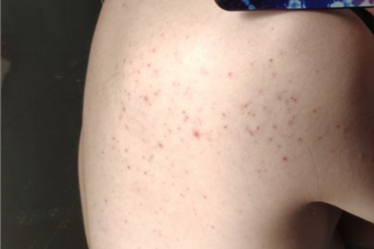 马拉色菌毛囊炎背部有小红疙瘩图