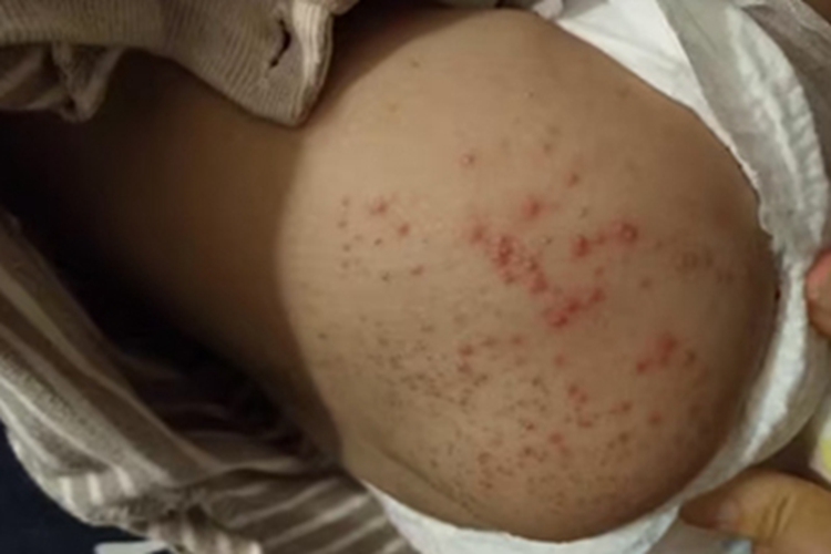 新生儿红斑臀部小红疙瘩图