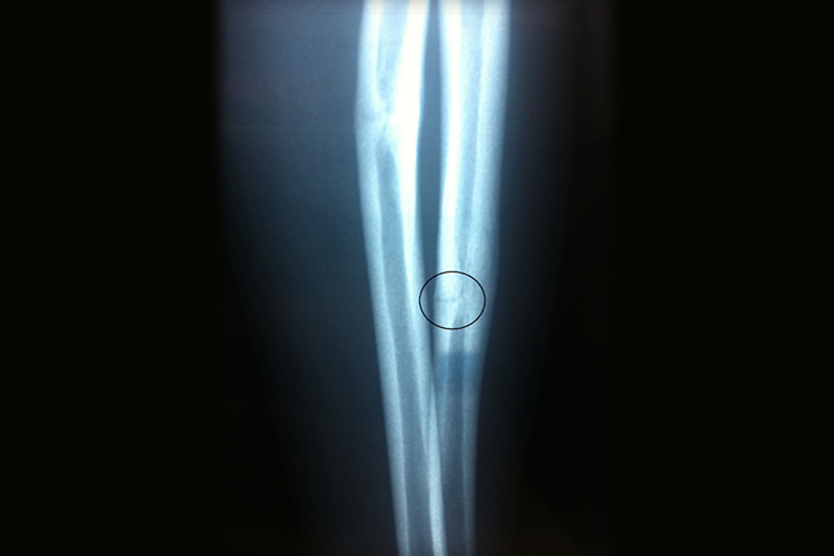 手臂轻微骨裂检查图 手臂轻微骨裂检查图