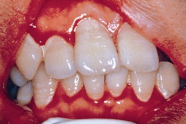 牙龈线性红斑症状图 牙龈线性红斑症状图