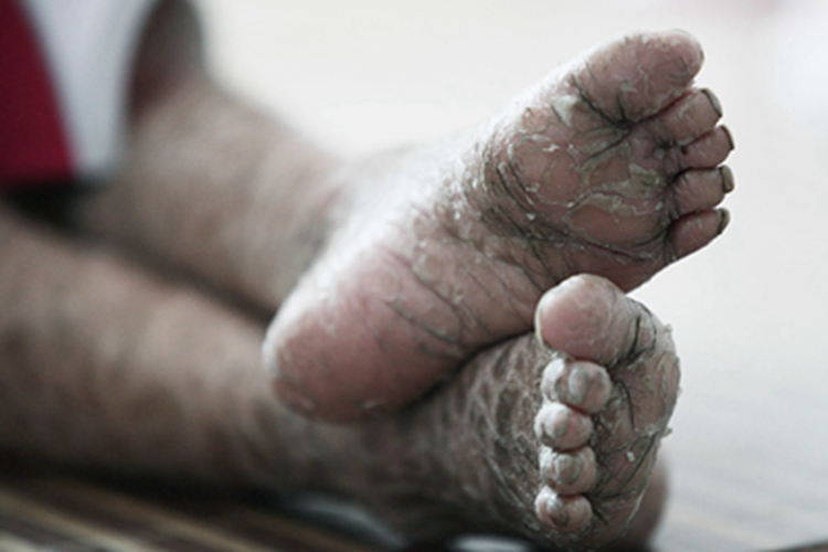 板层状鱼鳞病脱皮图