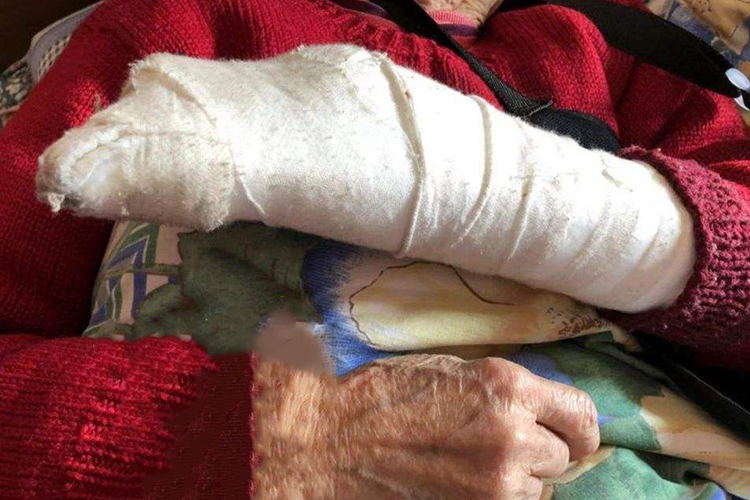 老人手腕石膏包扎图