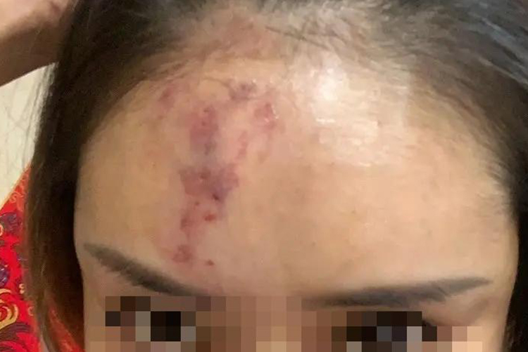 玻尿酸栓塞花斑图