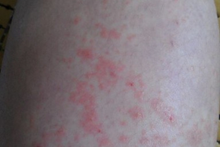 湿疹样紫癜大腿红斑图 湿疹样紫癜大腿红斑图