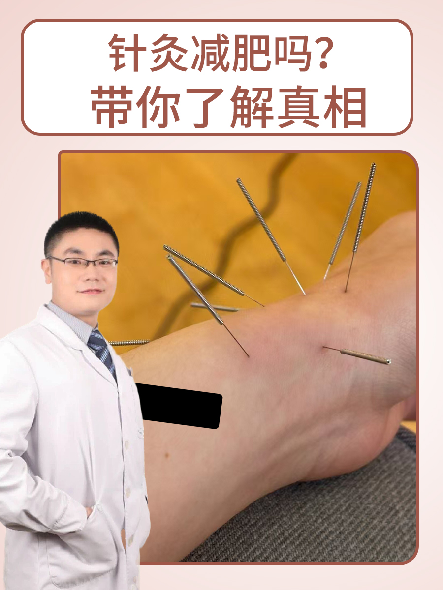 针灸减肥吗？带你了解真相