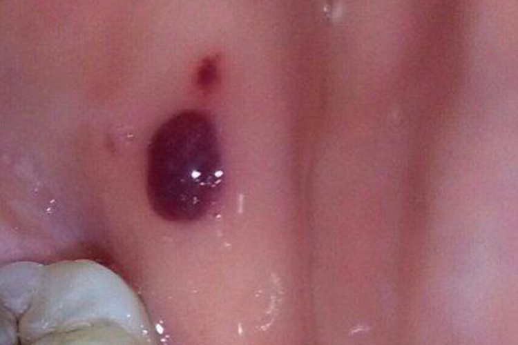 黏膜血疱图 黏膜血疱图