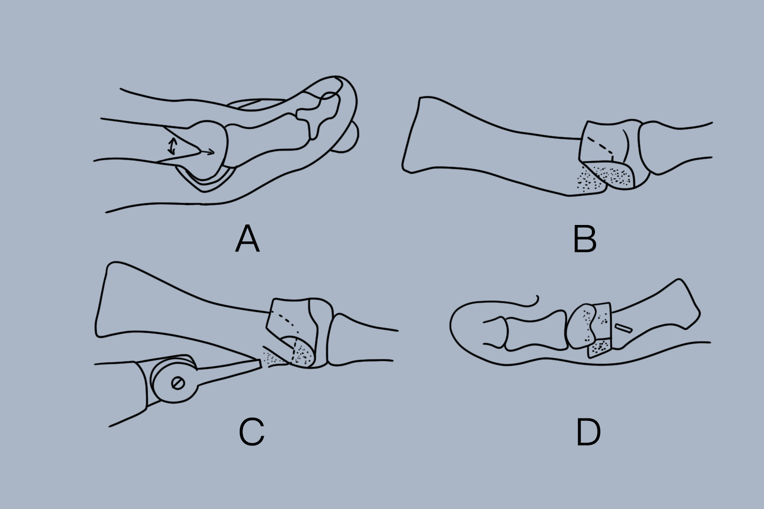 跖骨远端“V”形截骨过程图 跖骨远端“V”形截骨过程图